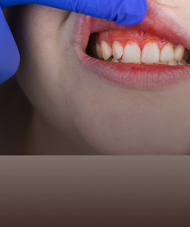 Bleeding Gums Treatment