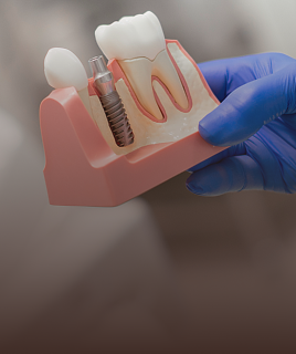 Dental Implants