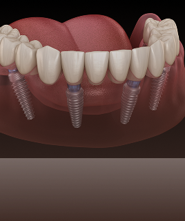 All-on-4 Implants