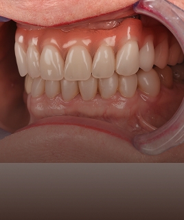 Full Mouth Implants