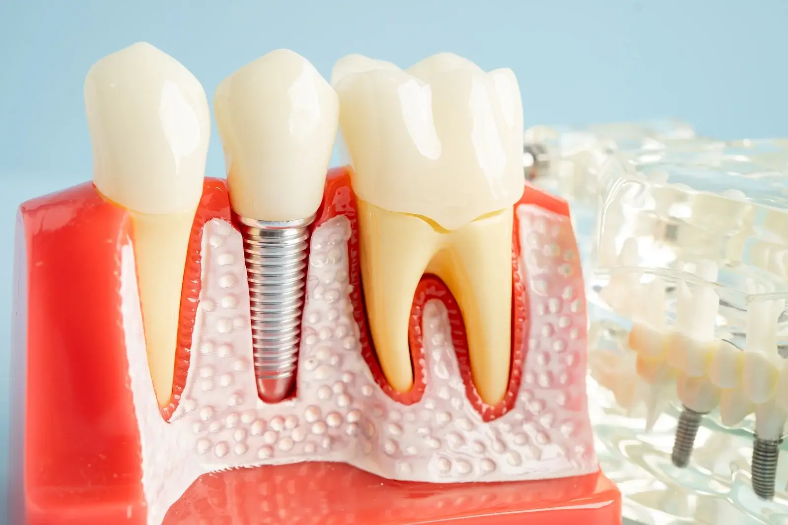 dental-implant-artificial-tooth-roots-into-jaw-root-canal-of-dental-treatment-gum-disease (1)