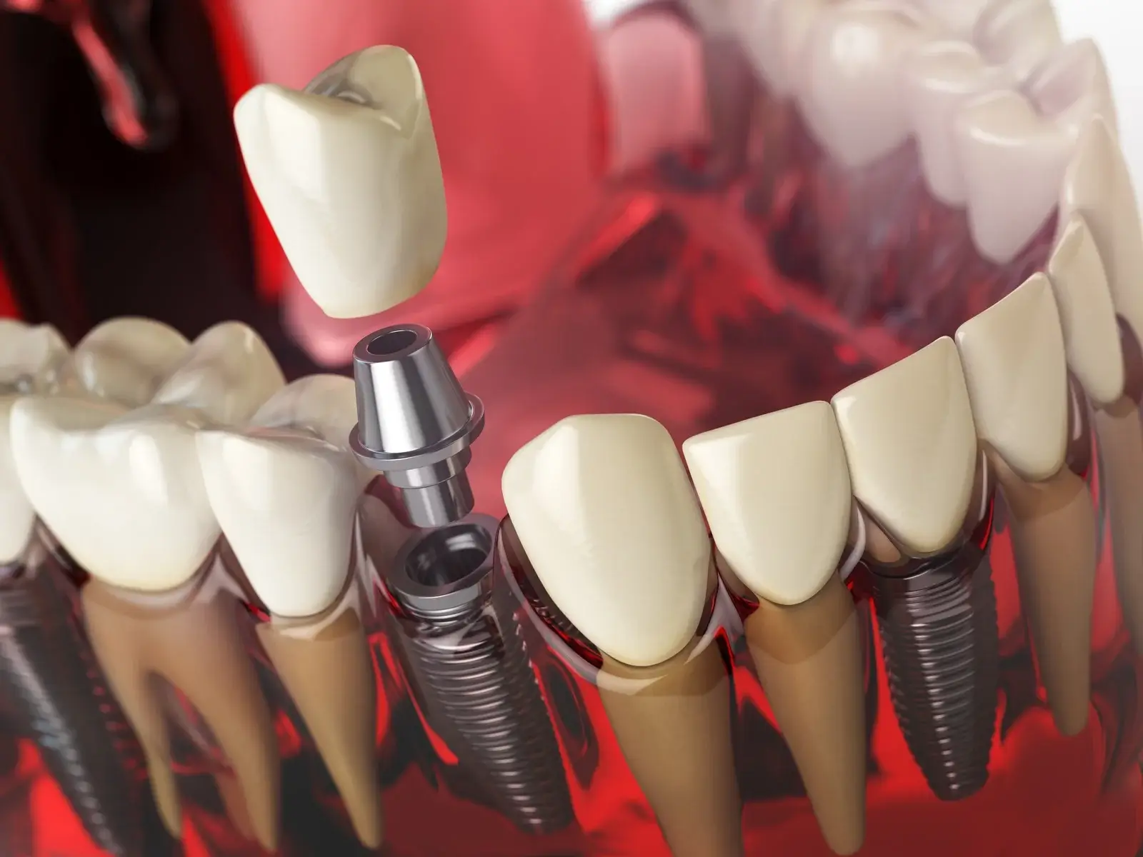 tooth-implant-in-the-model-human-teeth-gums-and-denturas-denta (1)