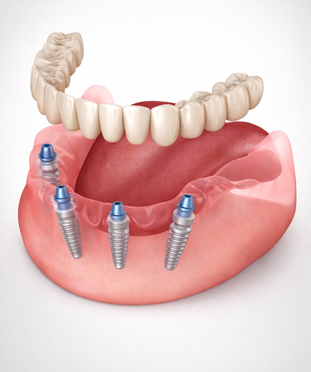 denture implants