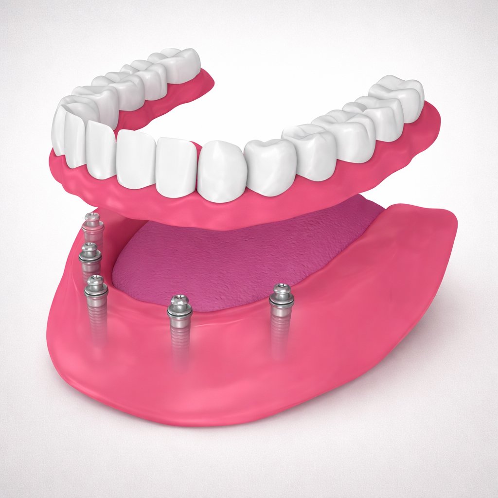 denture implants